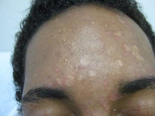 Pityriasis versicolor on the forehead