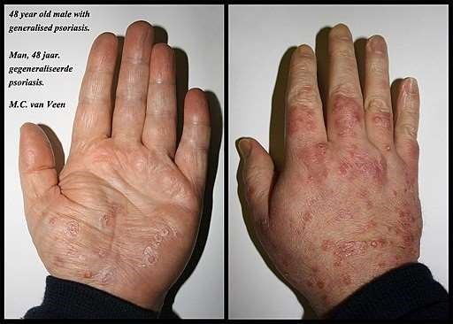 Psoriasis hands