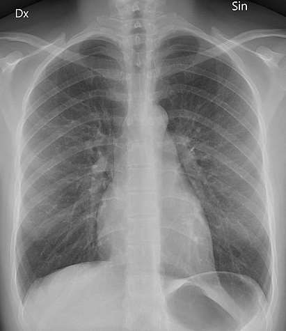 Chest X-ray PA