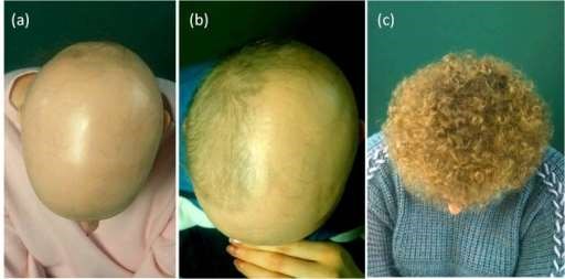 Alopecia half head treatment