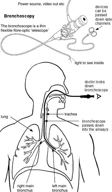 Diagram showing how a bronchoscopy is performed