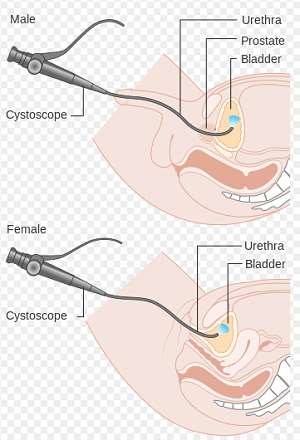 Cystoscopy: male and female