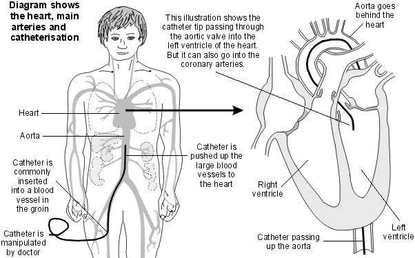 Cardiac catheterisation
