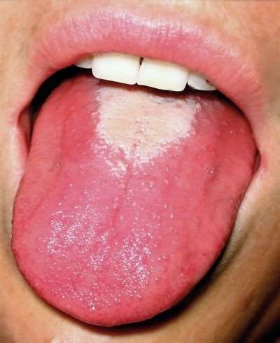 Strawberry tongue