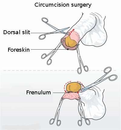 Circumcision, MrArifnajafov [CC-SA-1.0] via http://en.wikipedia.org/wiki/File:Circumcision_illustration.jpg