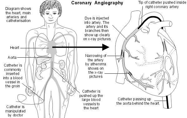 Coronary Angiography. Medical investigation into angina ...