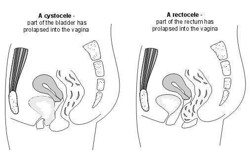 Cystocele and rectocele