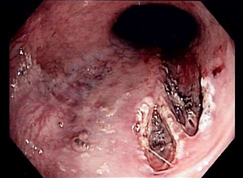 Mallory-Weiss tear endoscopic image