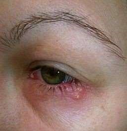 Herpes simplex eyelid