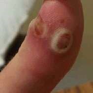 Orf virus on thumb
