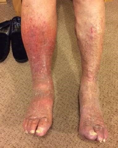 Patient photo of varicose eczema: patient consent obtained.