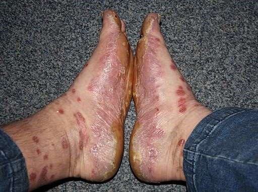 Psoriasis feet