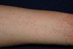 Scabies on the arm