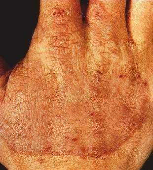 Dermatophytosis (Tinea Infections). Medical information. Patient | Patient