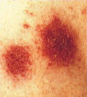 DISCOID ECZEMA -TYPICAL LESIONS