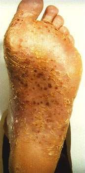 Palmoplantar pustulosis foot