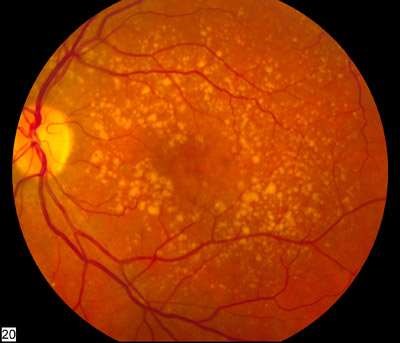 Fundus photo showing dry ARMD