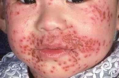 eczema herpeticum in a young child