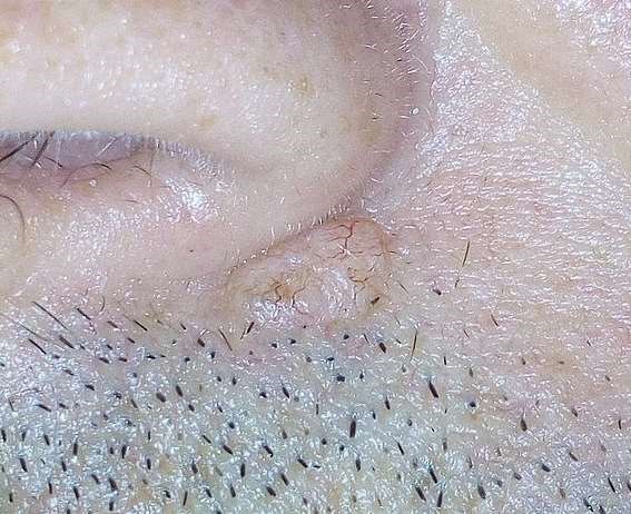 Basal cell carcinoma under the nose