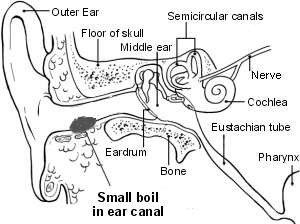 Boil in the ear canal (Beverley Kenny)