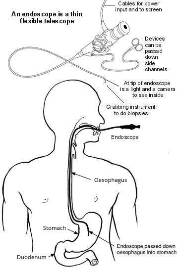 endoscopy after effects