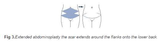Extended abdominoplasty