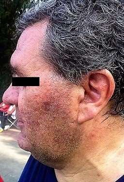 Rosacea in an adult male