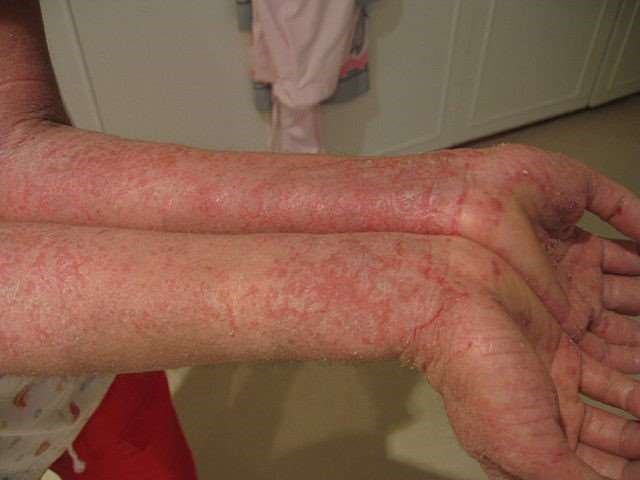 Atopic eczema on arms