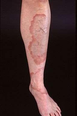 GENERALISED GRANULOMA ANNULARE - LEG