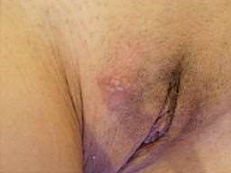 Genital herpes woman