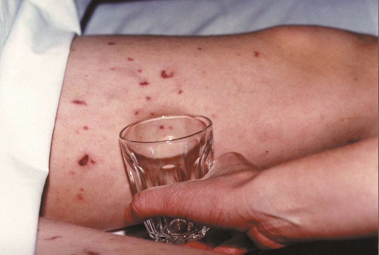 Glass test for meningitis rash