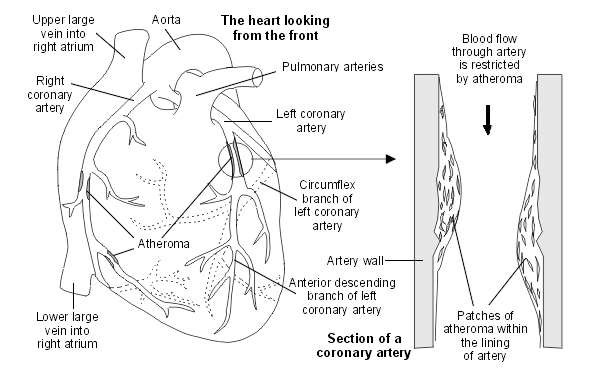 Heart with atheroma