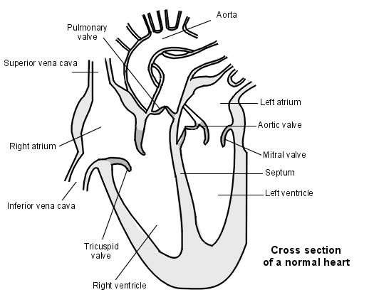 Ventricular Septal Defect | Hole in the Heart | Patient