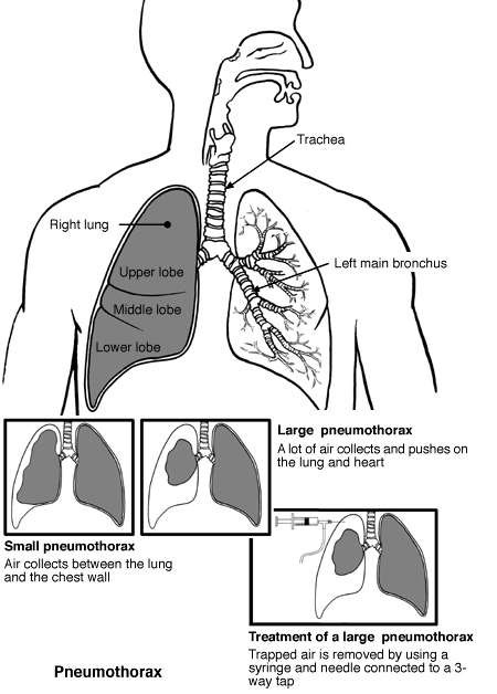 Pneumothorax | Diagram | Patient