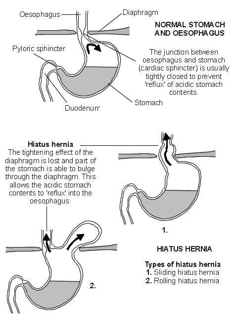 Hiatus hernia | Diagram | Patient