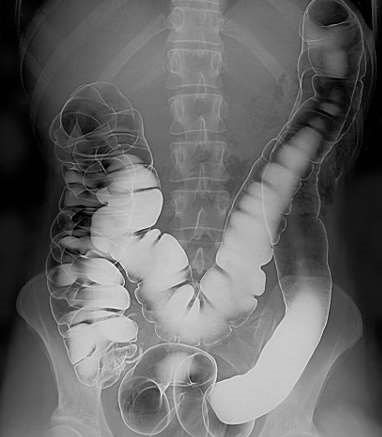 Human intestinal tract imaged via double-contrast barium enema