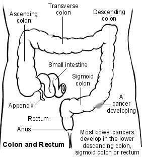 Large bowel showing a cancer