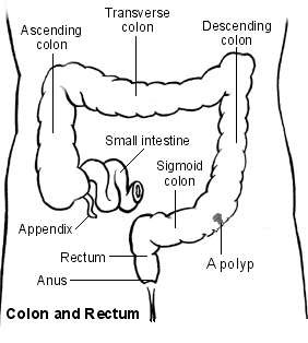 Large bowel showing a polyp