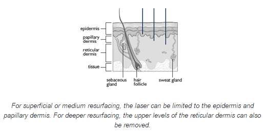 Laser resurfacing