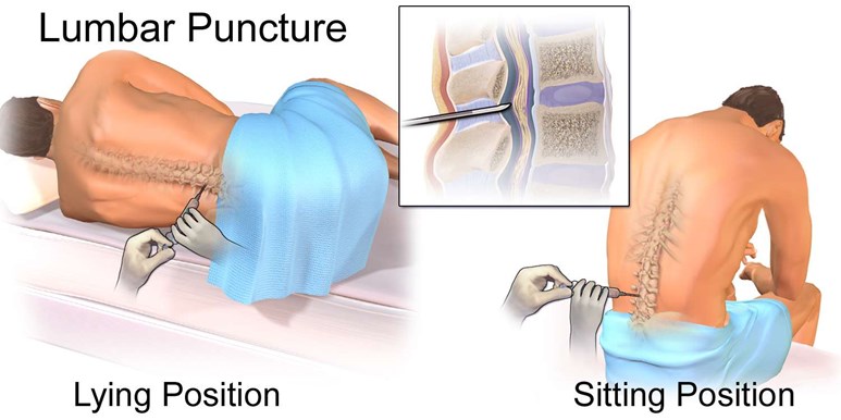 Lumbar Puncture (Spinal Tap) | Procedure & Side Effects | Patient