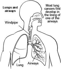 Lungs and airway - lung cancer
