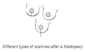 Mastopexy scarlines