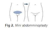Mini abdominoplasty