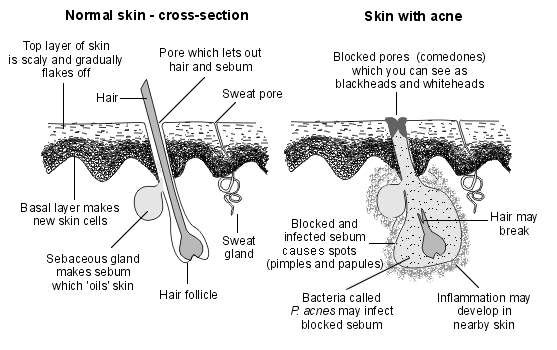 Normal skin and acne skin