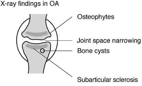 Osteoarthritis X-ray
