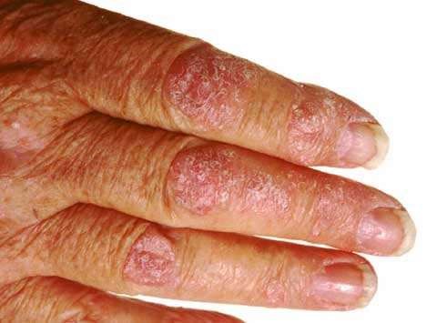 Chronic Plaque Psoriasis. Symptoms, causes and treatment | Patient