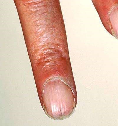 Fingernails tiny dents in Slide show: