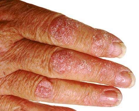 Nail Disorders and Abnormalities. Medical Information | Patient