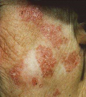 Discoid Lupus Causes Symptoms And Treatment Patient