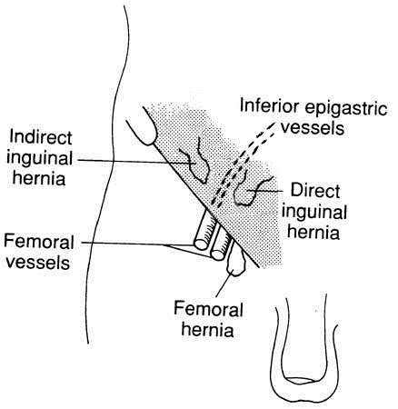 Inguinal Hernias. What is an inguinal hernia? Groin lump | Patient